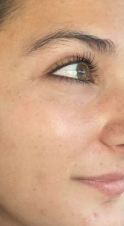 The same cheek after a course of Green Sea Peel treatments, clear and even