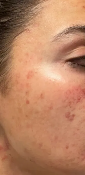 A client's cheek before treatment at Luxe 4 You, with active breakouts and redness