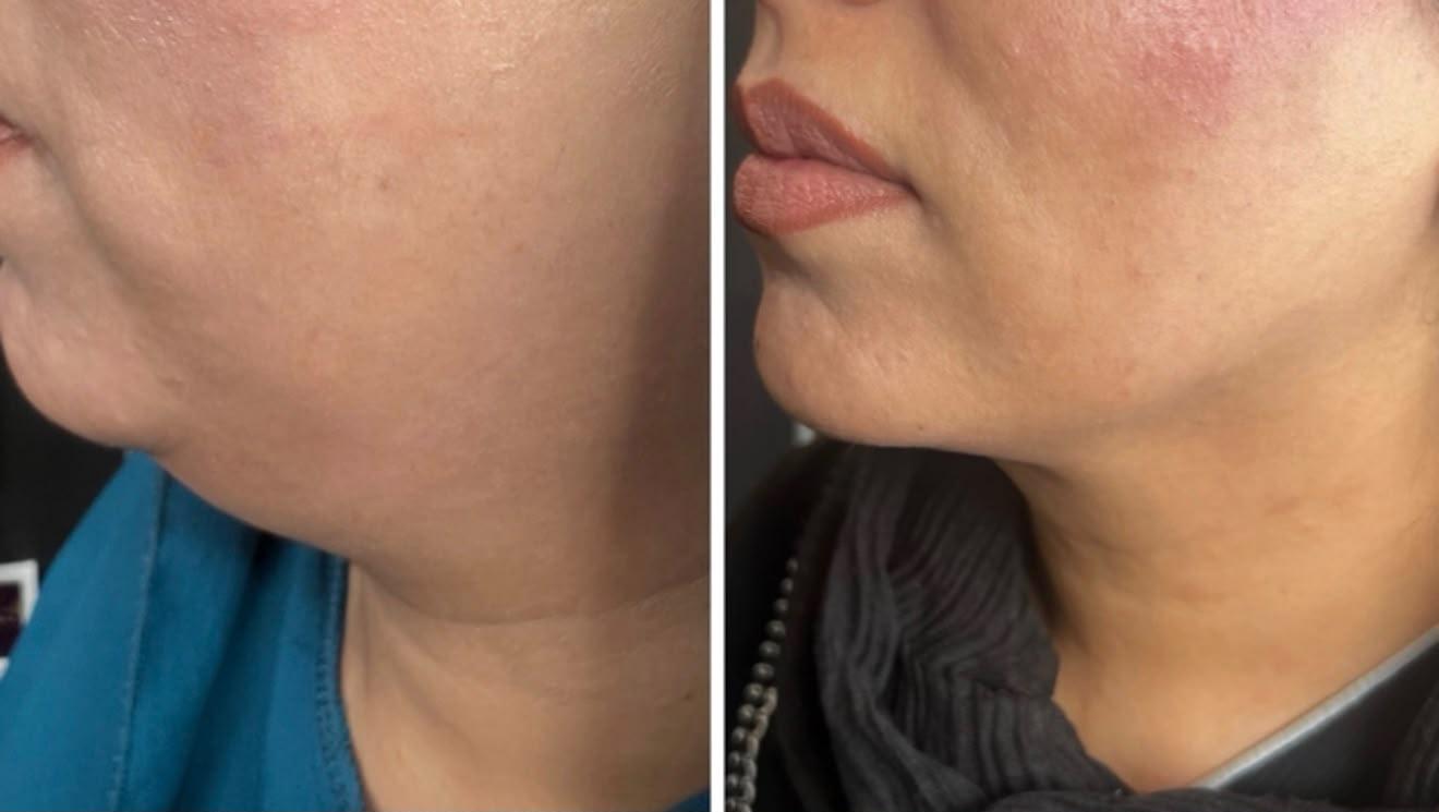 Before and after Lemon Bottle fat dissolving treatment at Luxe 4 You in Sheffield, showing a more defined jawline and chin profile