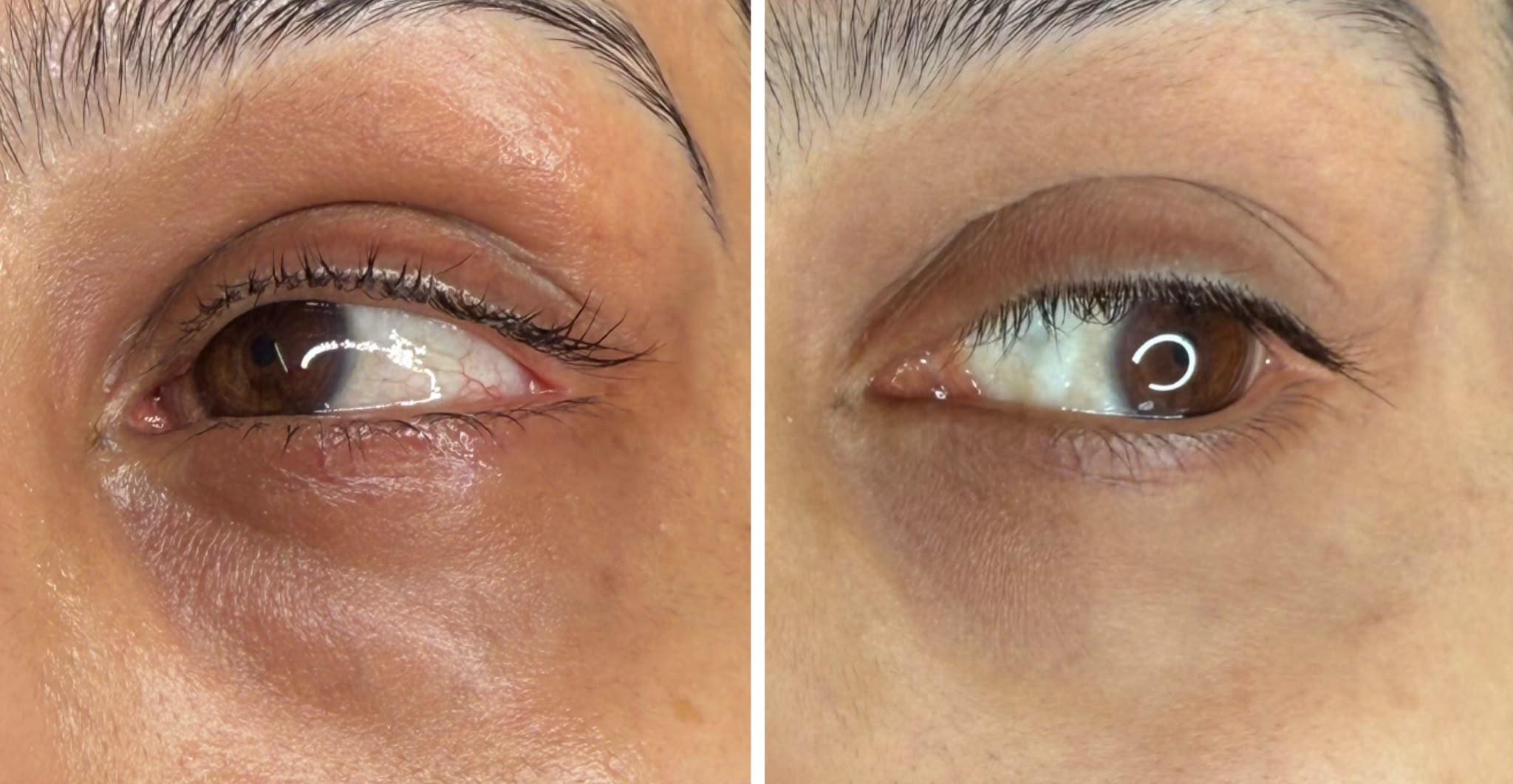 Before and after an under-eye treatment at Luxe 4 You in Sheffield, showing reduced puffiness and dark circles